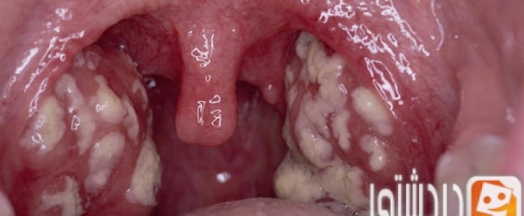 أسباب صديد اللوز وعلاجها