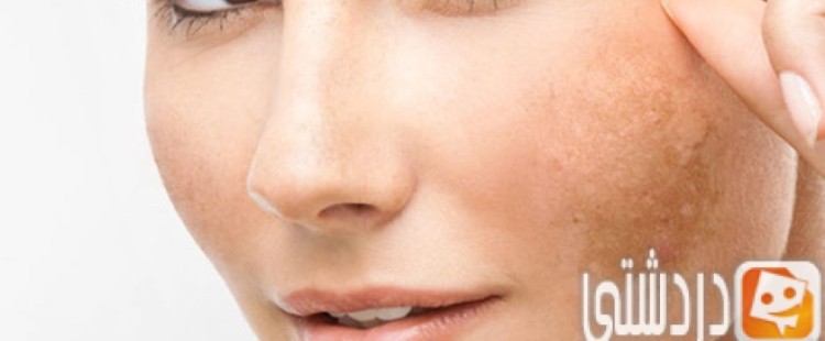 ما هي أسباب الكلف وطرق التخلص منه