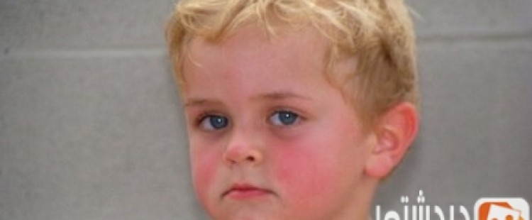 ما علاج إحمرار الوجه وأسبابه