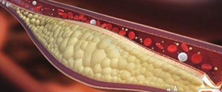 أسباب إرتفاع الكوليسترول في الدم