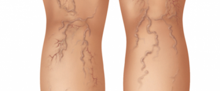 أسباب دوالي الساقين وطرق علاجها