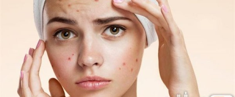 وصفات طبيعية لإزالة حب الشباب من المنزل