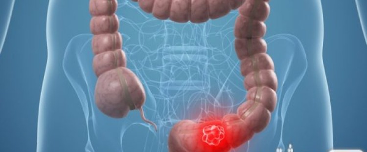 أعراض سرطان القولون وكيفية علاجه