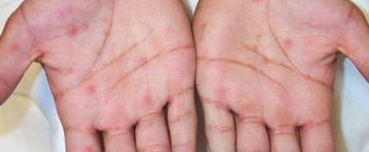 أعراض مرض الزُّهري وطرق علاجه