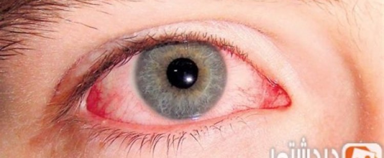 ما أسباب قرحة القرنية وكيفية الوقاية منها
