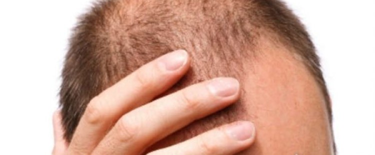 أسباب مرض الثعلبة وكيفية علاجها