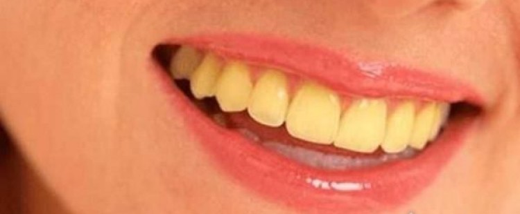 طرق طبيعية للتخلص من صفار الأسنان