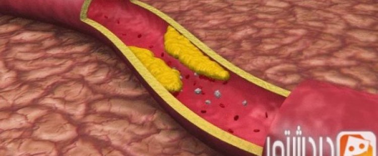 أسباب إنسداد الشرايين وطرق علاجه
