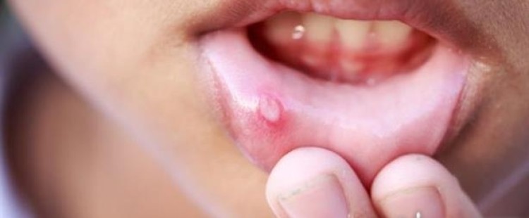 أسباب تقرحات الفم وعلاجها