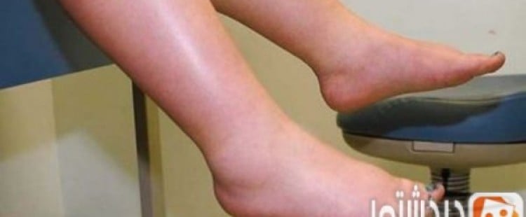 أعراض إحتباس السوائل في الجسم