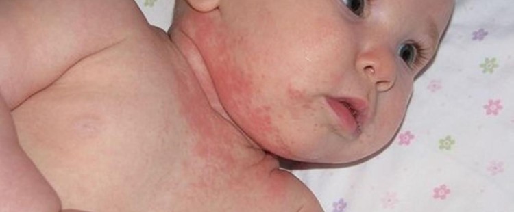 طرق علاج حساسية الجلد عند الأطفال