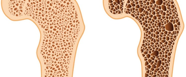 أسباب هشاشة العظام وعلاجها