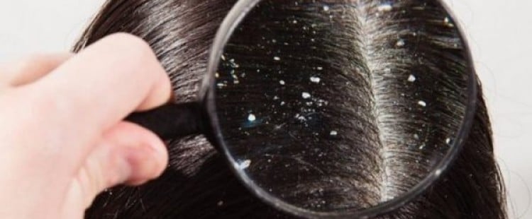 علاج قشرة الشعر