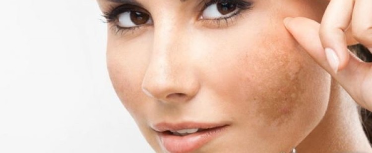 علاج تصبغات الجلد بطرق طبيعية