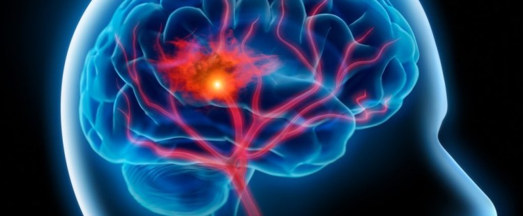 أسباب نزيف المخ