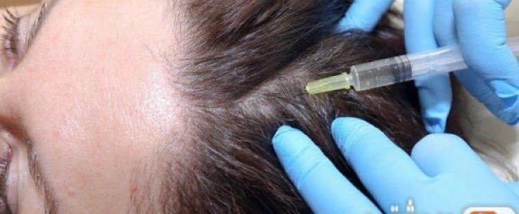 مخاطر حقن البلازما للشعر
