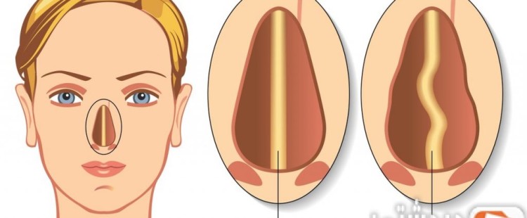 أسباب انحراف الوتيرة وعلاجها