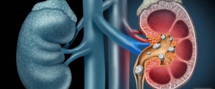 أسباب حصوات الكلى وعلاجها
