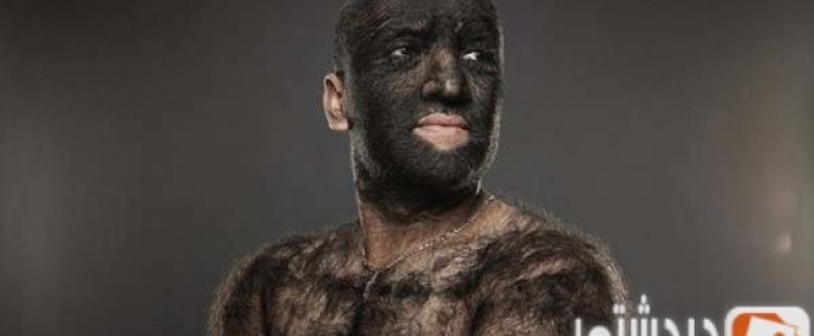 أسباب متلازمة أمبراس والعلاج