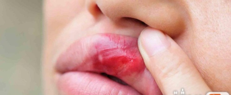 أعراض سرطان الفم وعلاجه