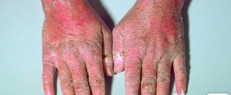 علاج مرض البلاغرا