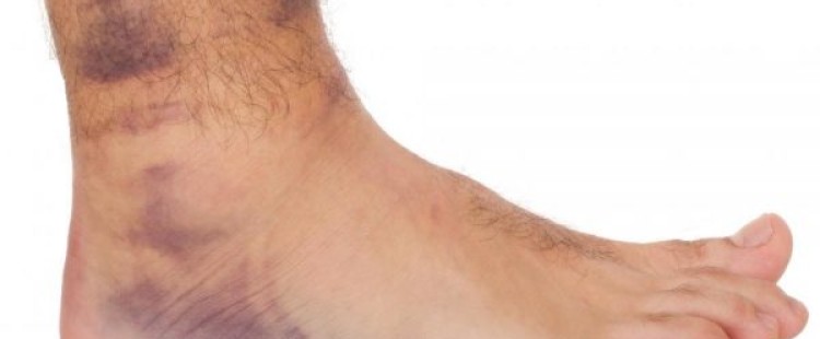 أسباب تورم الكاحل و علاجه