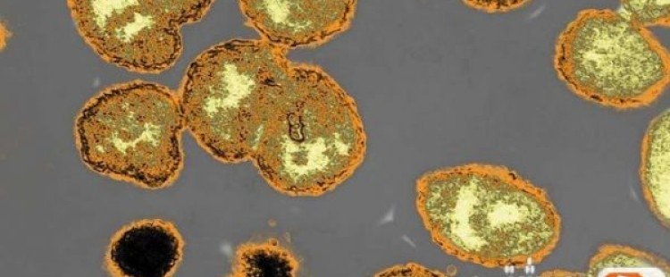 أعراض مرض السيلان والعلاج