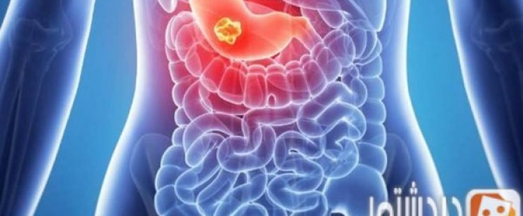 أسباب القرحة الهضمية وكيفية علاجها