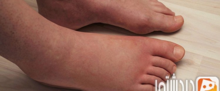 أعراض استسقاء العظم