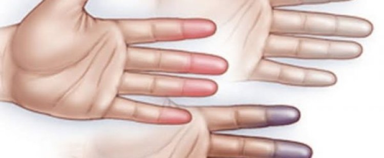 أسباب مرض بورغر وعلاجه