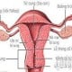 أعراض قصور عنق الرحم وعلاجه