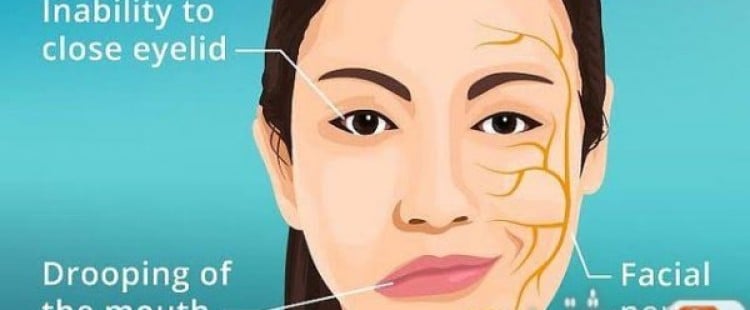 أعراض شلل العصب الوجهي وعلاجه
