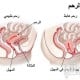 هبوط الرحم أسباب وأعراض وعلاج
